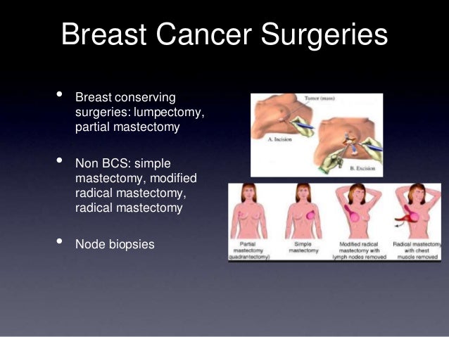 breast lump mast Breast lump mast